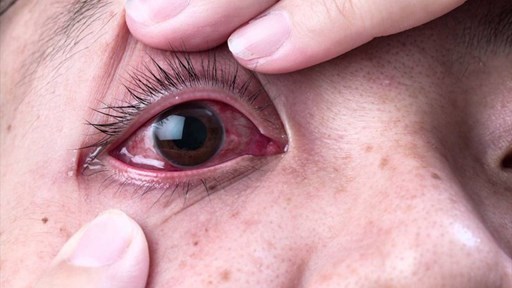 Bệnh Đau Mắt Đỏ Là Gì? Nguyên Nhân & Cách Điều Trị